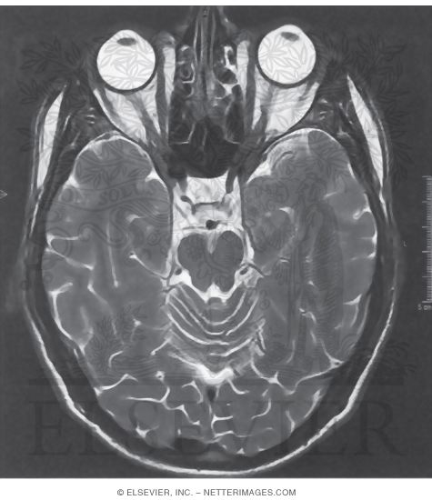 Watermarked preview of unlabeled image: MRI of the Brain