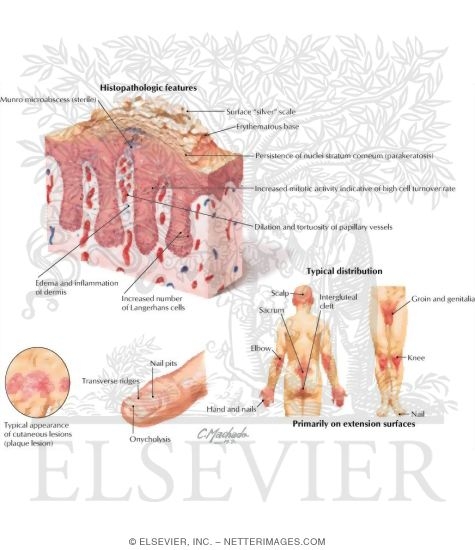 Watermarked preview of labeled image: Psoriasis: Clinical Correlation