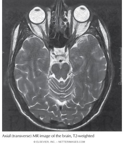MRI of the Brain