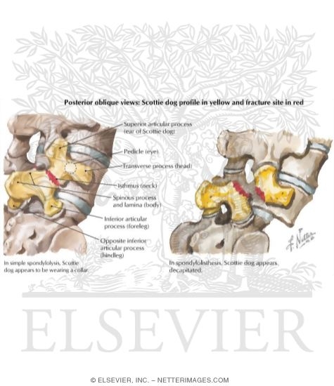 Spondylolysis and Spondylolisthesis
