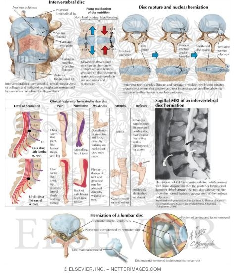 Intervertebral Disc Herniation