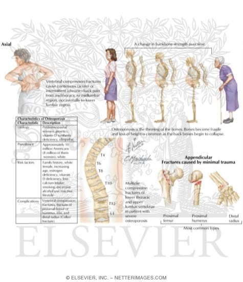 Osteoporosis