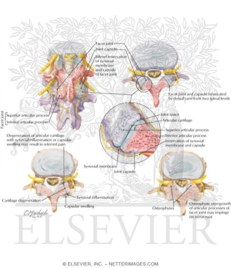 Watermarked preview of labeled image: Back Pain Associated With Vertebral Facet Joints