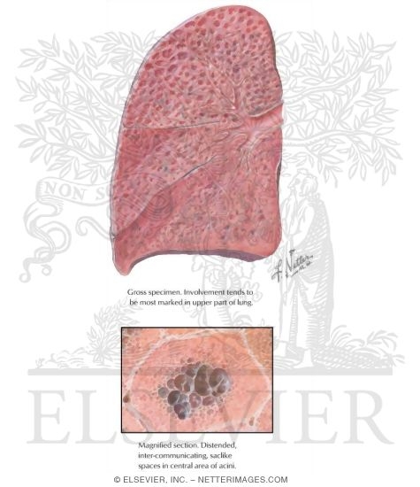Watermarked preview of labeled image: Centriacinar (Centrilobular) Emphysema