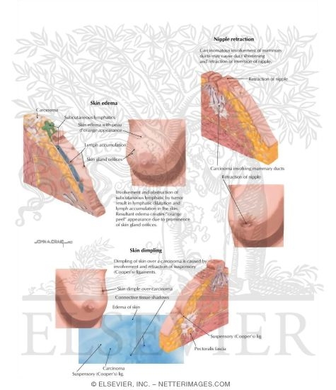 Watermarked preview of labeled image: Breast Cancer