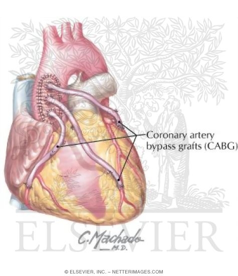 Watermarked preview of labeled image: Coronay Bypass