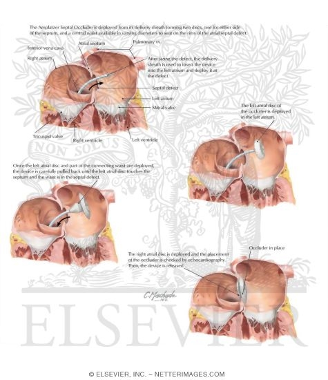 Watermarked preview of labeled image: Amplatzer Septal Occluder