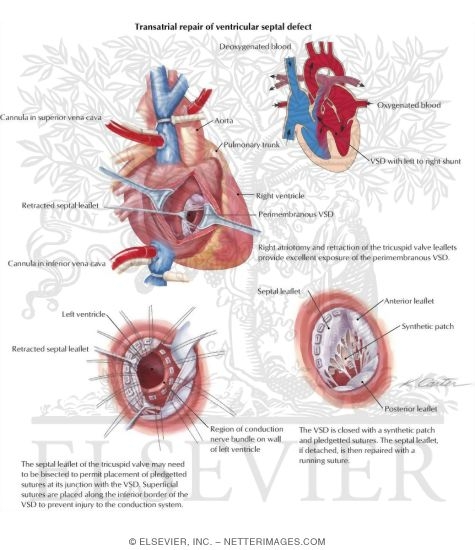 Transatrial Repair of Ventricular Septal Defect (VSD)