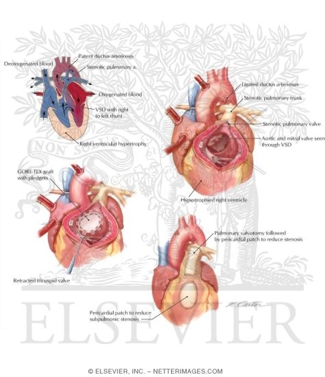 Watermarked preview of labeled image: Tetralogy of Fallot