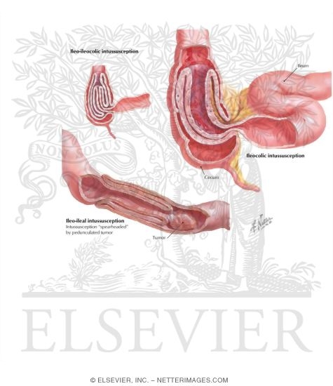 Watermarked preview of labeled image: Intussusception