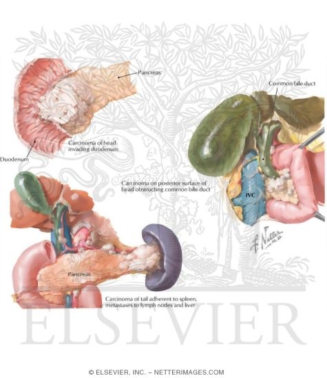 Watermarked preview of labeled image: Malignant Tumors II - Carcinoma, Gross Pathology and Clinical Features