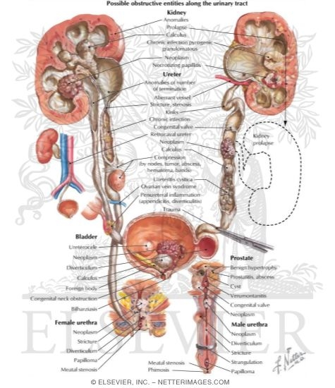 Obstructive Uropathy: Etiology