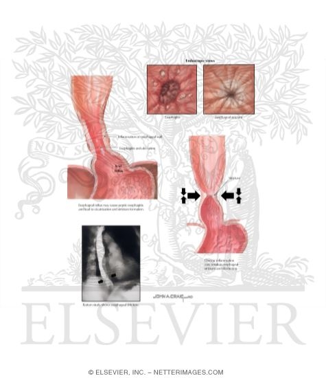 Watermarked preview of labeled image: Gastroesophageal Reflux Disease