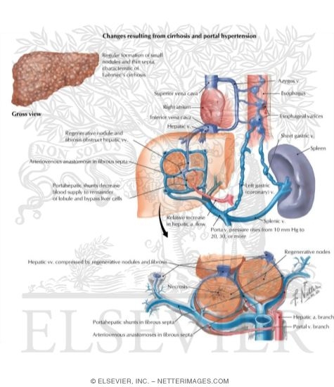 Watermarked preview of labeled image: Etiology of Cirrhosis