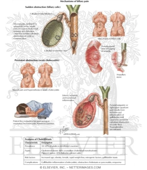 Watermarked preview of labeled image: Cholelithiasis (Gallstones)