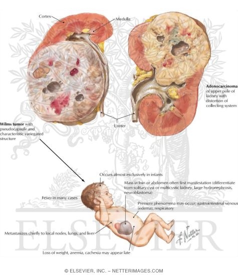 Watermarked preview of labeled image: Malignant Tumors of the Kidney