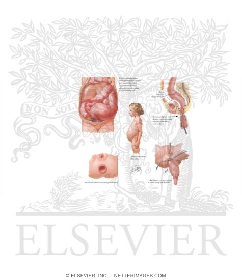 Watermarked preview of labeled image: Congenital Megacolon (Hirschsprung's Disease)
