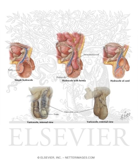 Hydrocele and Varicocele