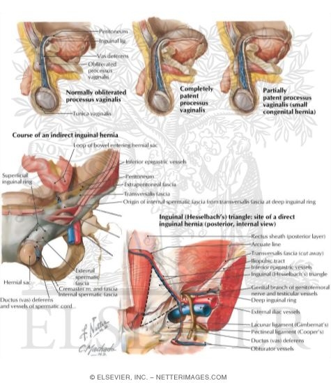 Watermarked preview of labeled image: Inguinal Hernias