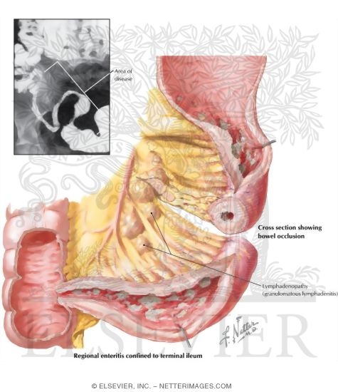 Crohn Disease