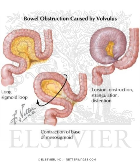 Volvulus