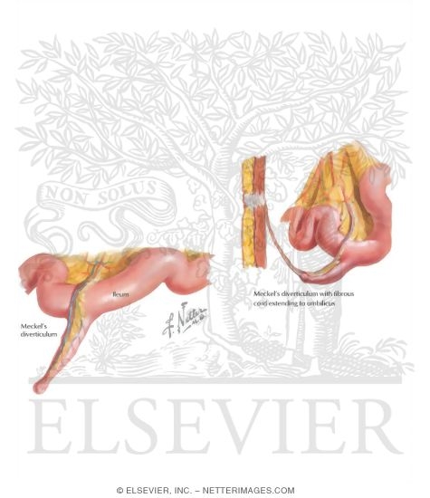 Watermarked preview of labeled image: Meckel's Diverticulum
