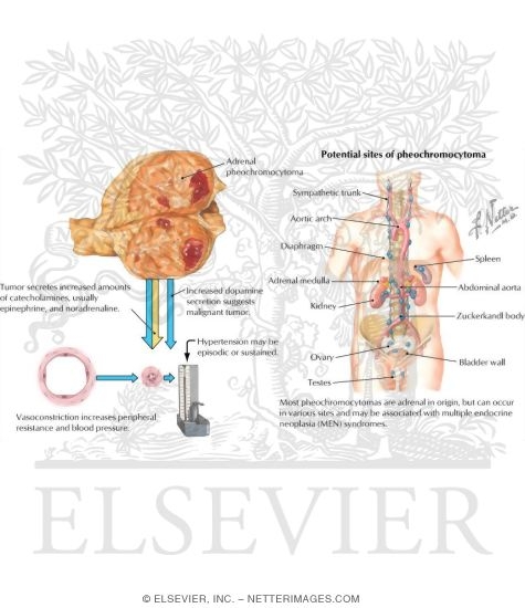 Pheochromocytoma