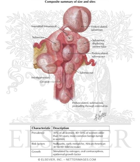Myoma (Fibroid) I - Locations