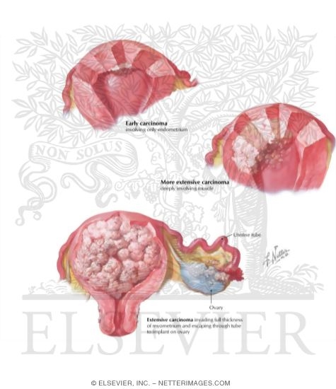 Watermarked preview of labeled image: Cancer of Corpus I - Various Stages and Types