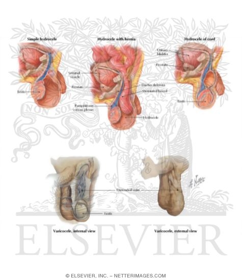 Watermarked preview of labeled image: Hydrocele and Varicocele