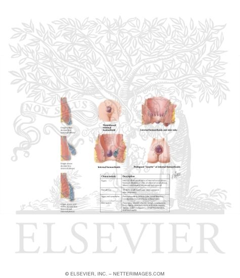 Hemorrhoids