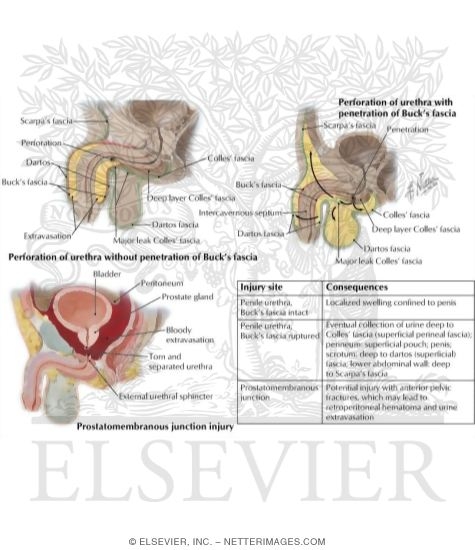 Urine Extravasation