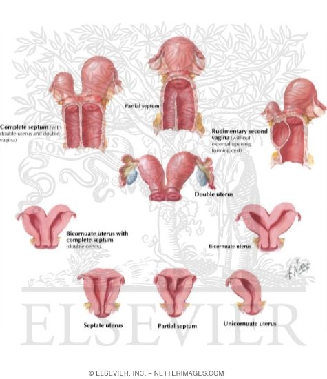 Watermarked preview of labeled image: Paramesonephric Duct Anomalies