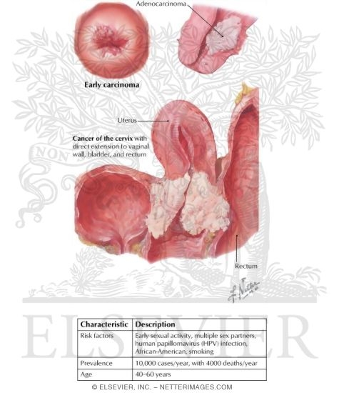 Cervical Cancer