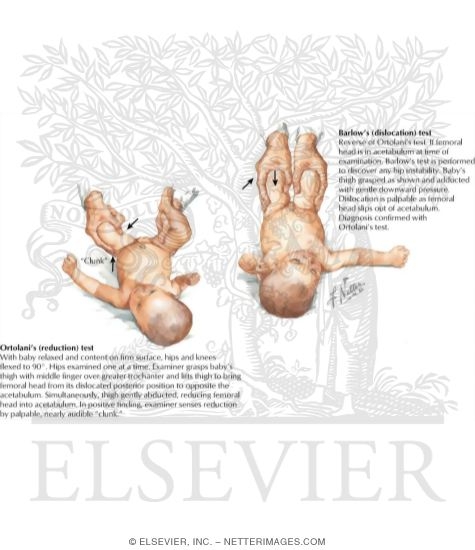 Watermarked preview of labeled image: Recognition of Congenital Dislocation of the Hip
