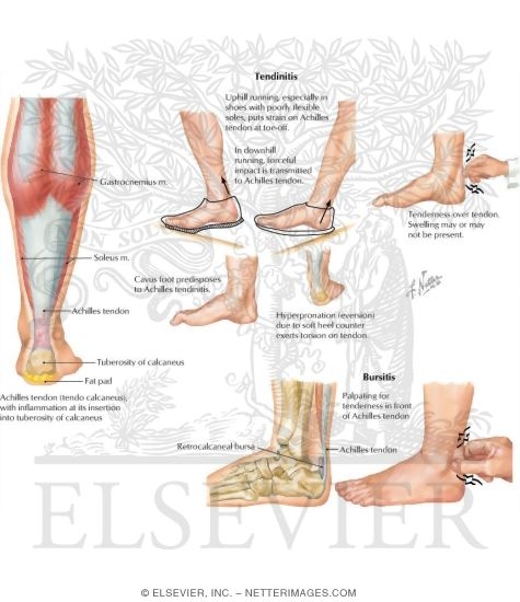Achilles Tendinitis: Retrocalcaneal Bursitis