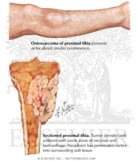 Osteosarcoma