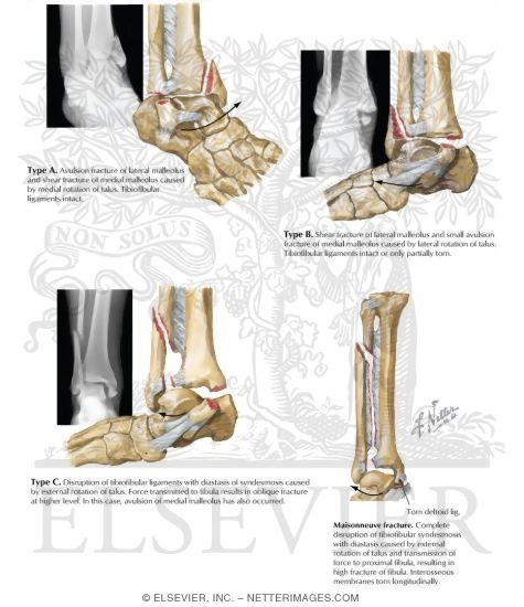 Watermarked preview of labeled image: Rotational Fracture of Ankle Mortise
