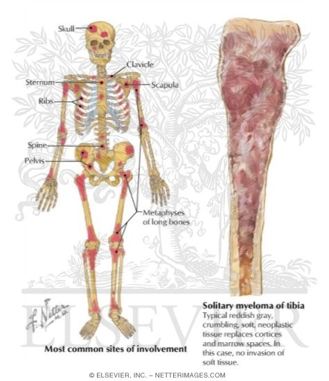 Multiple Myeloma