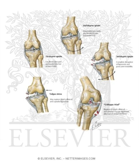 Watermarked preview of labeled image: Sprains of Knee Ligaments