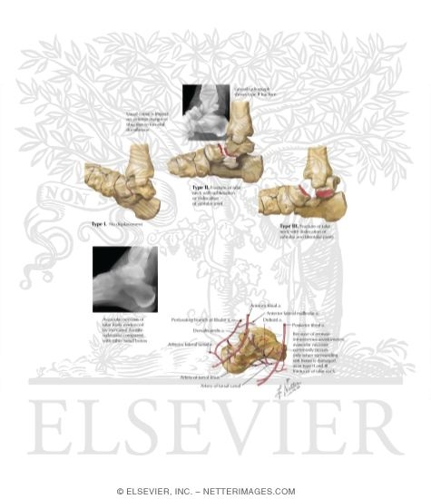 Watermarked preview of labeled image: Fractures of the Talar Neck