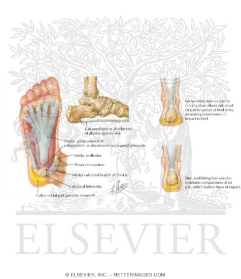 Watermarked preview of labeled image: Plantar Fasciitis