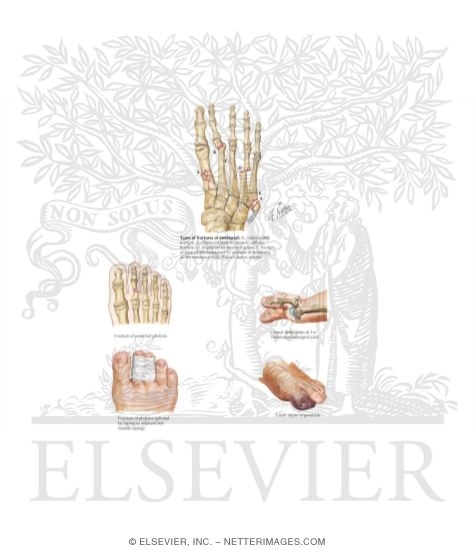 Watermarked preview of labeled image: Injury to Metatarsals and Phalanges
