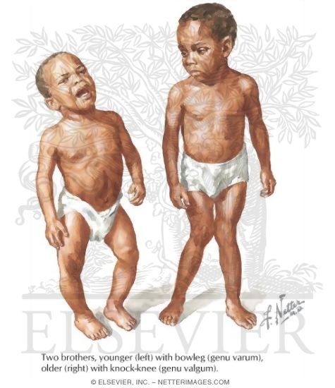 Watermarked preview of labeled image: Genu Varum and Valgum