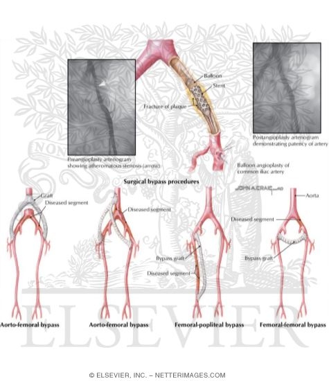 Percutaneous Peripheral Angioplasty