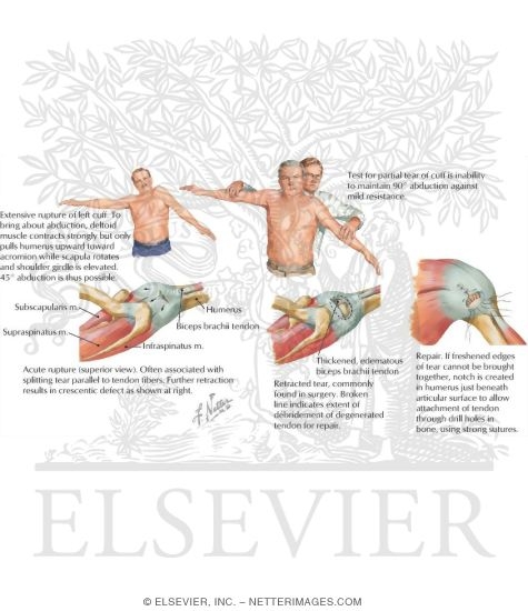 Watermarked preview of labeled image: Tears and Ruptures of Rotator Cuff
