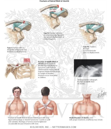 Watermarked preview of labeled image: Clavicular Fractures