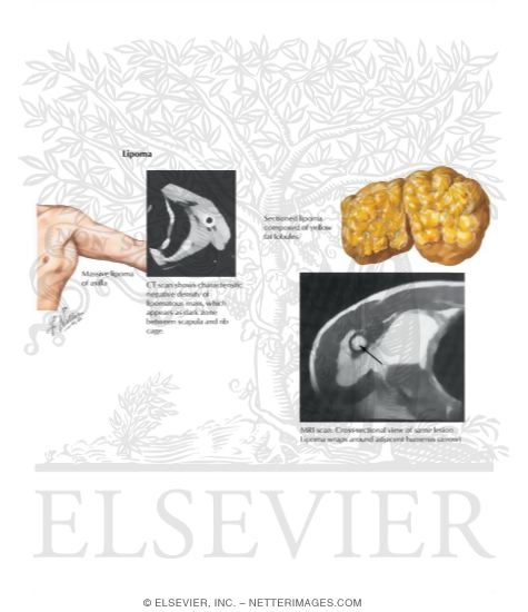 Soft Tissue Tumor of the Axilla