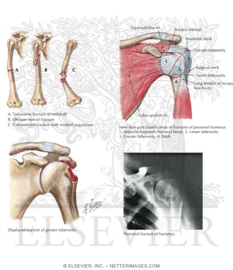 Watermarked preview of labeled image: Fractures of the Humerus