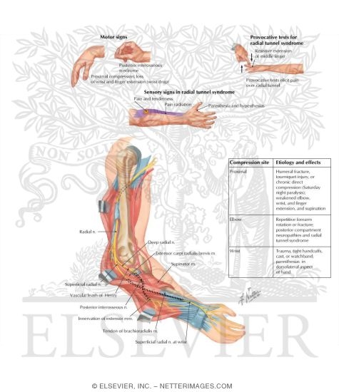Radial Nerve Compression